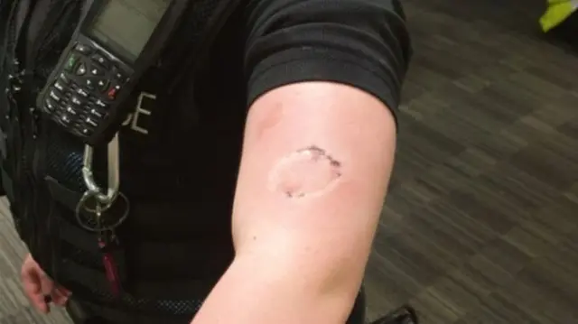 Police officer's bite mark