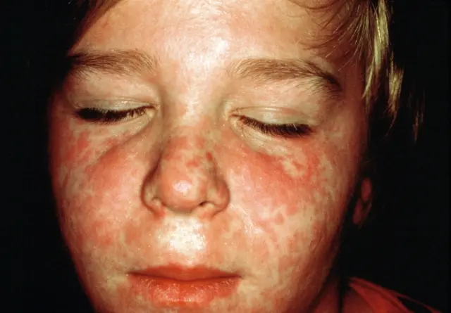 Measles rash on a child’s face. File photo