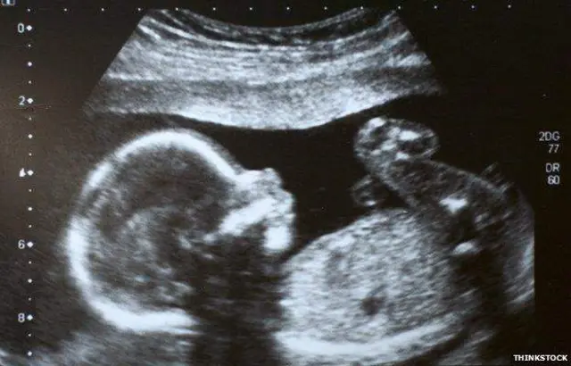 baby ultrasound