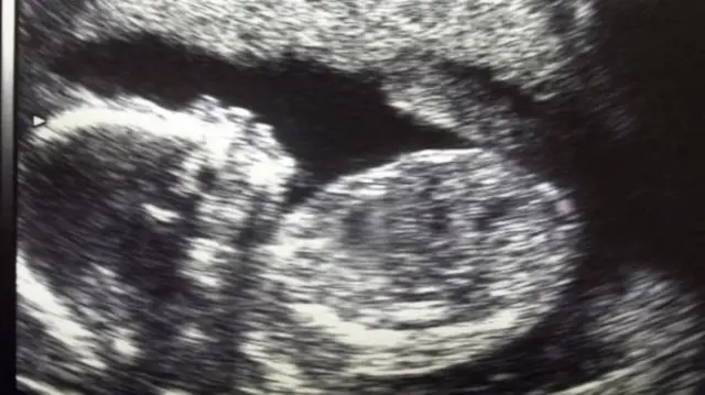 Ultrasound scan