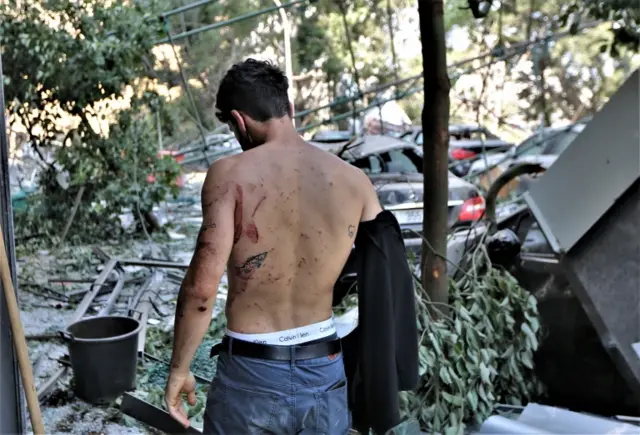 A Lebanese person shows injuries on the back after the massive explosion in Beirut, Lebanon, 05 August 2020