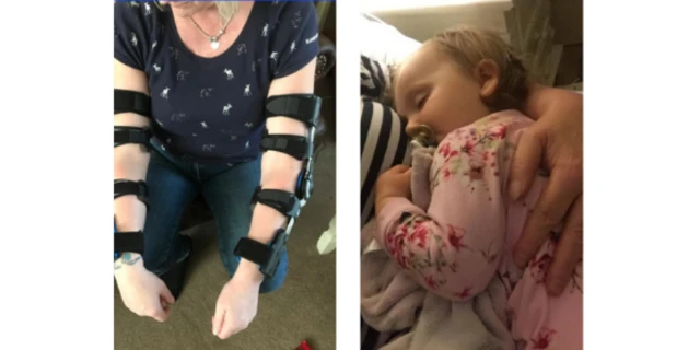 Mandy Taylor's dislocated elbows, and her grandaughter