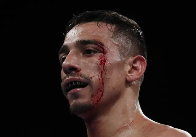 A cut above eye of Luis Alberto Lopez