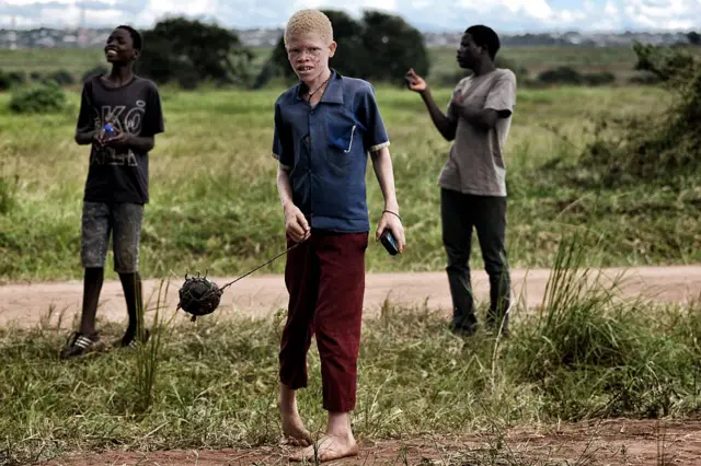 A boy with albinism looks on as he plays with a self-made ball in the outskirts of Lilongwe - March 2016