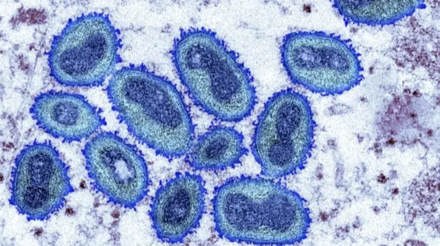 Coloured transmission electron micrograph (TEM) showing monkeypox virus particles from a human skin sample