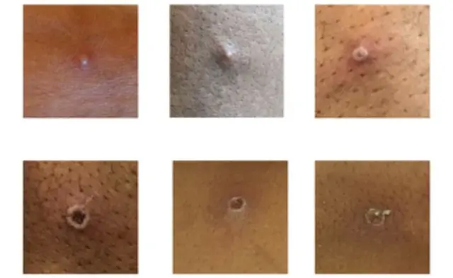 The rash changes and goes through different stages, and can look like chickenpox or syphilis, before finally forming a scab, which later falls off