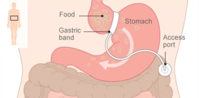 bariatric surgery graphic