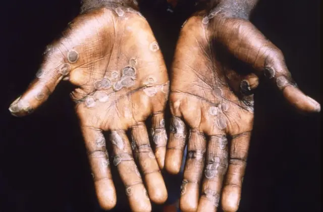 Monkeypox lesions