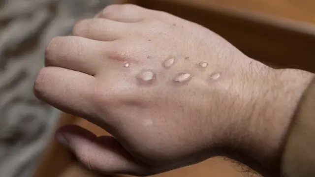 Monkeypox seen on a man's hand.