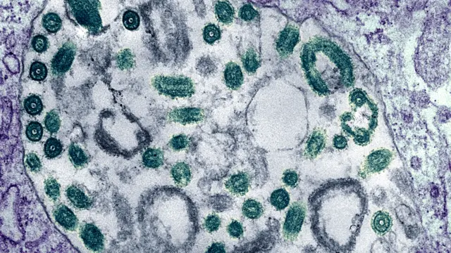 Electron Micrograph Of The Marburg Virus. Marburg Virus,