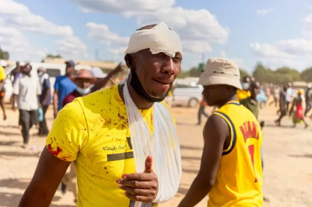 A wounded supporter of the opposition Citizens Coalition for Change is seen bandaged at an electoral rally following an attack allegedly provoked by ruling ZANU PF supporters on February 27, 2022 at Mbizo shopping centre in Kwekwe