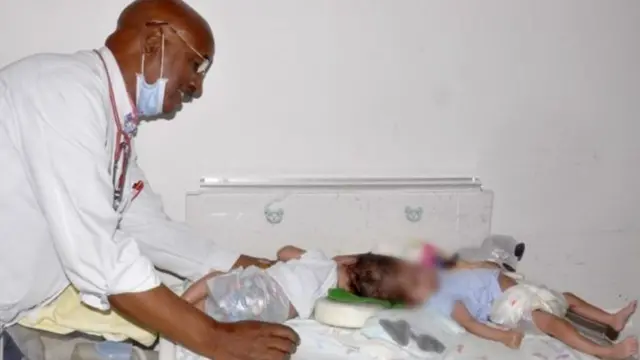 The conjoined twins in Eritrea