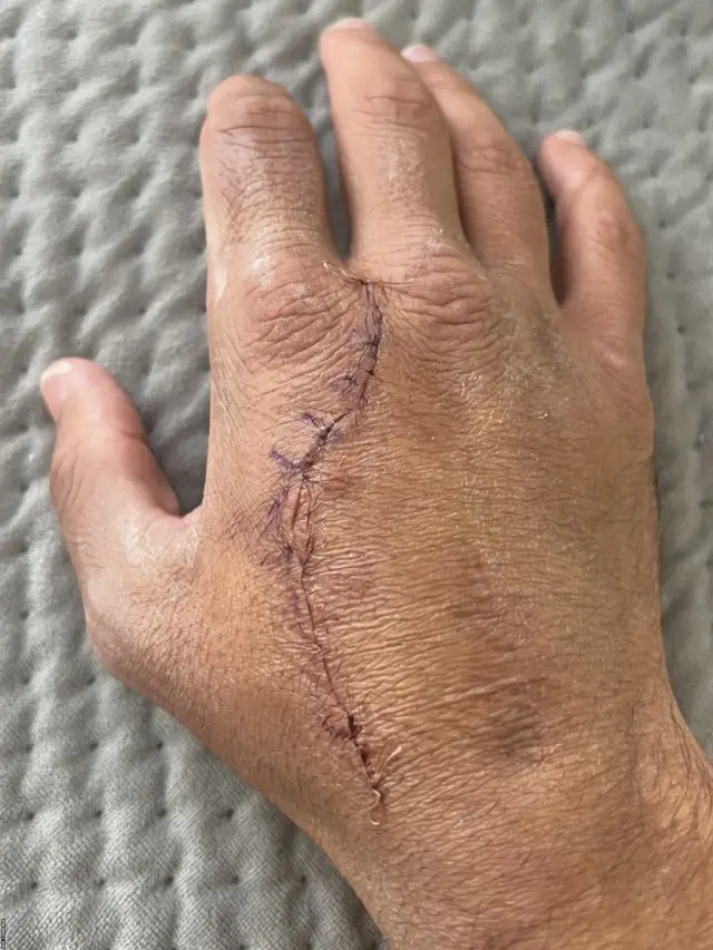 Picture of scar running down Joe Cordina's hand