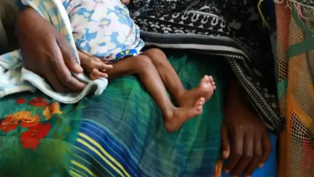 A woman holds a malnourished infant