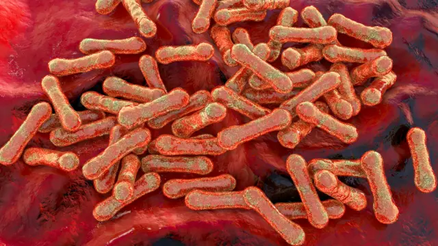 Diphtheria is characterised by the formation of fibrin-containing membranes on the tonsils and on the surface of the respiratory tract that can lead to respiratory obstruction (difficulties in breathing)