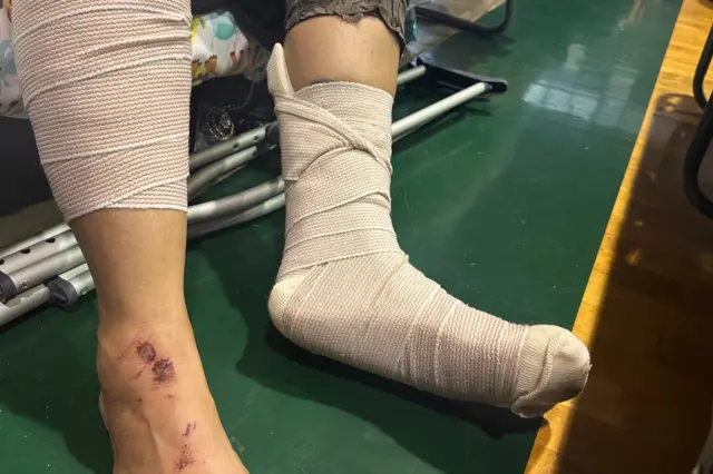 Teressa's injured foot