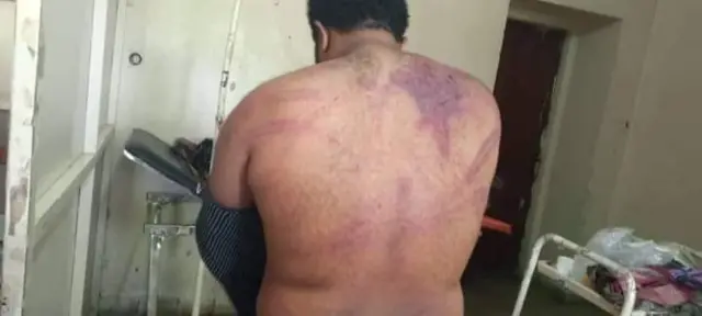 The back of a man who was beaten in Mekelle - 7 September 2023