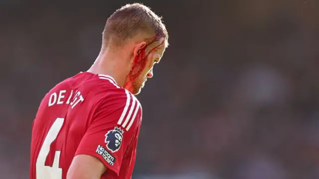 Matthijs de Ligt of Manchester United with a blooded head