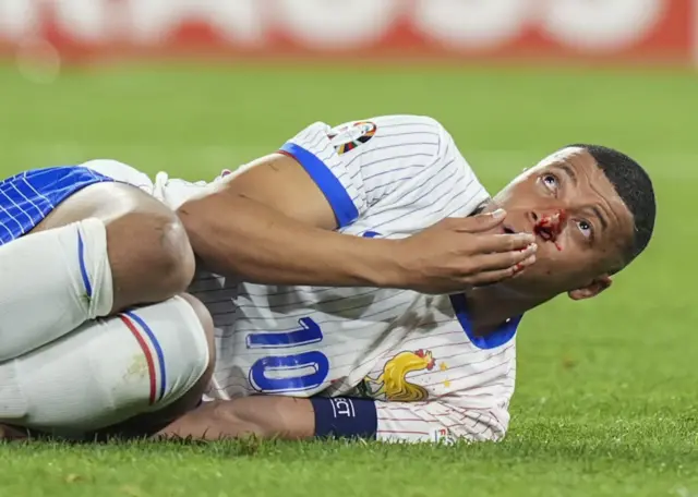 Kylian Mbappe has a bloodied nose after injuring it against Austria