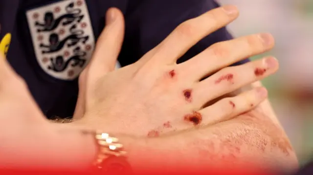 Anthony Gordon's hand after suffering a bike accident