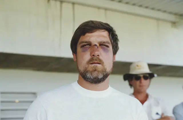 MIke Gatting with bruises after batting against the West Indies