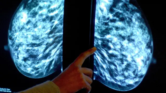 A physician examines a mammogram of a woman's breast (file picture)