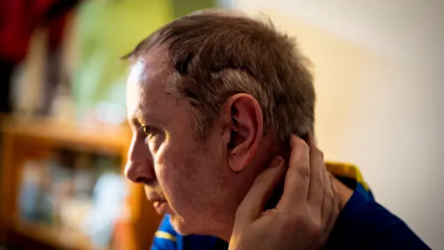 Crean facing left, showing the left side of his head. there are stitches above the ear