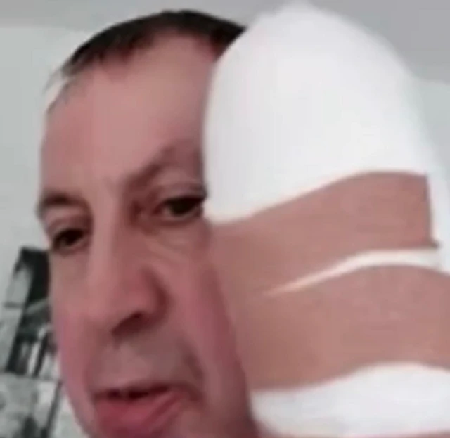 Stephen Crean looking at camera with a bandage on his hand.