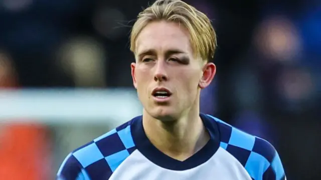 Calvin Miller with a shiner