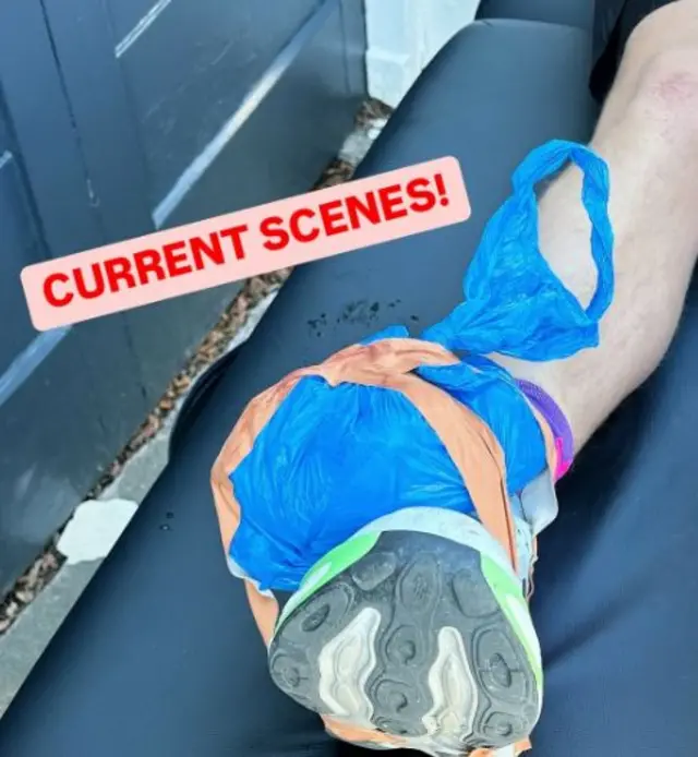 An ice pack is strapped to Jamie's leg as he lies on a massage table