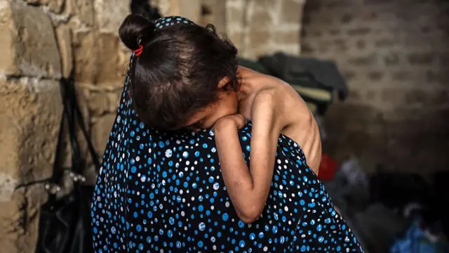 A malnourished child is held by an adult.