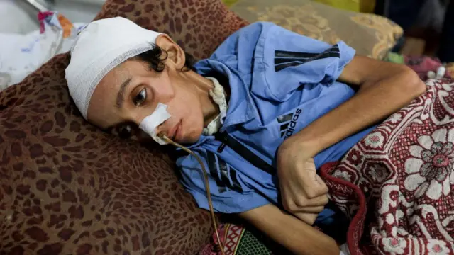 A 14-year-old Palestinian boy, who medics say is malnourished, lies on a bed at Al-Shifa Hospital in Gaza.