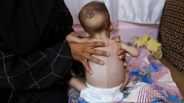 Seela Barbakh, an 11-month-old Palestinian girl who is malnourished, according to medics, is held by her mother, Najah, at Nasser Hospital in Khan Younis, in the southern Gaza Strip, on Wednesday