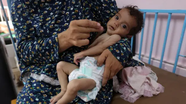 A Palestinian woman holds her 5-month-old daughter, Rama Abu Aya, who is malnourished, at a hospital.