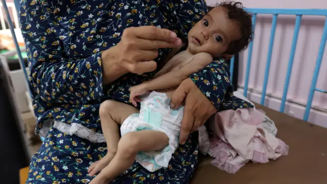A malnourished child in Gaza