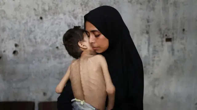 Displaced Palestinian mother Samah Matar holds her malnourished son Youssef, who suffers from cerebral palsy. He is wearing a plastic bag as a nappy.
