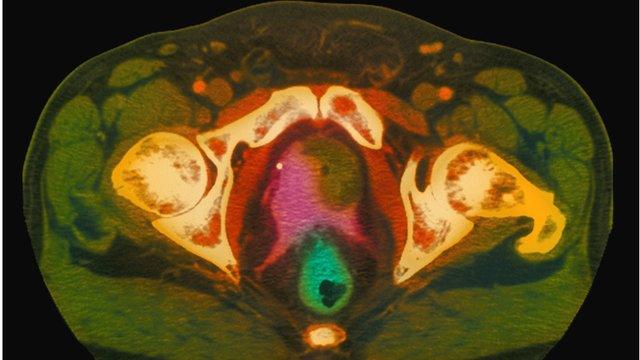 Scan of human pelvis showing prostate cancer (dark green)