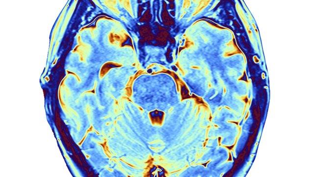 Brain scan. False-colour magnetic resonance imaging (MRI) scan of a human head containing a healthy brain, seen in horizontal view.