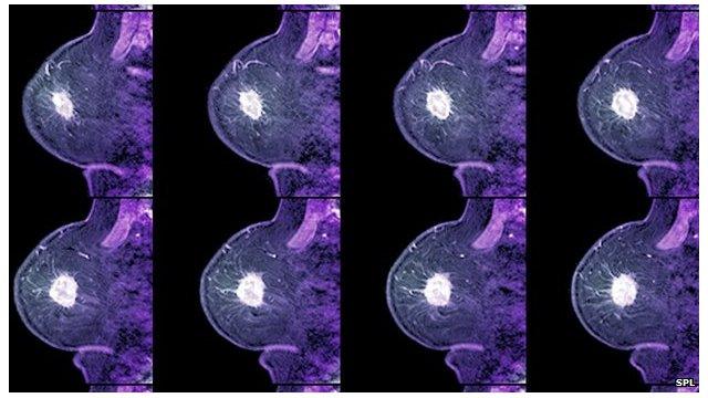 Breast cancer scans