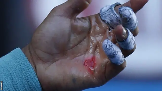 Nadal's blister