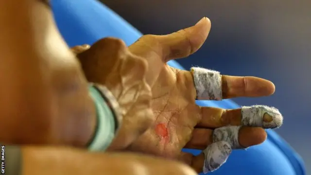 Rafael Nadal's blistered hand