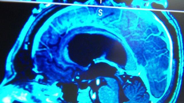 Brain tumour scan