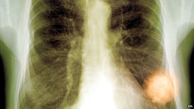 Chest x-ray showing a suspected tumour