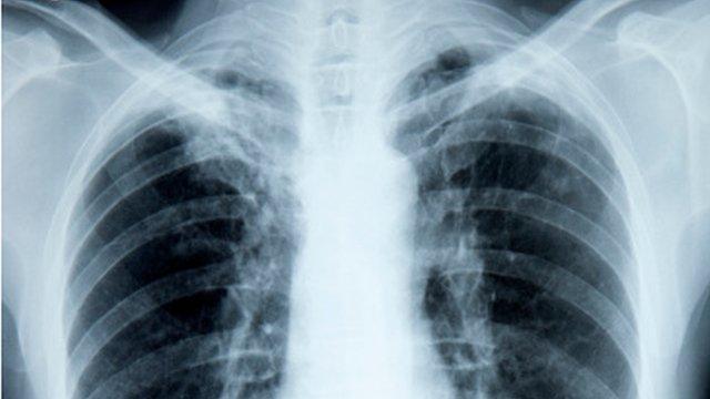 Chest X-ray