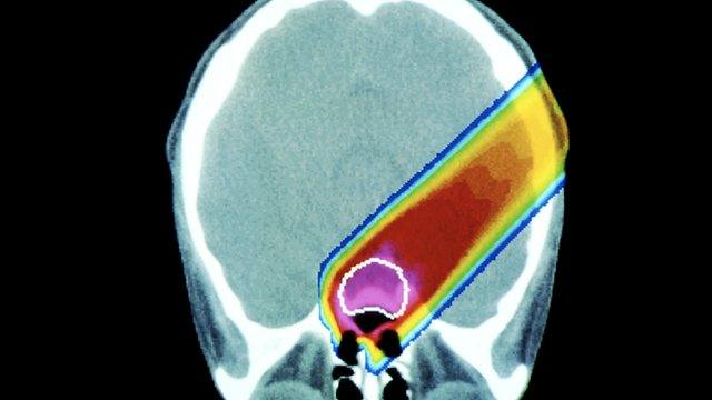 A scan showing the pathway of radiation through a tumour