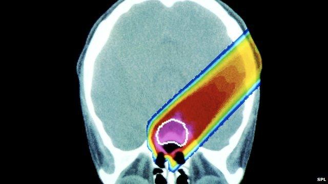 A scan showing the pathway of radiation through a tumour