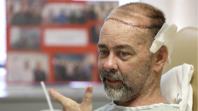 James Boysen received a skull and scalp transplant