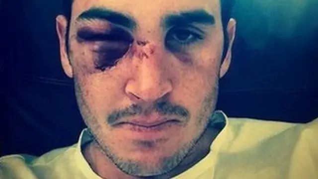 Craig Kieswetter tweeted a picture of his injuries in July