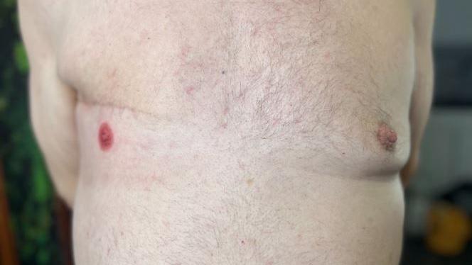 A picture of Dave's torso showing his nipple tattoo underneath his operation scar on his right breast