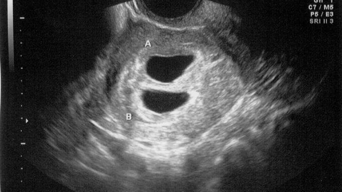 A generic image of an ultrasound scan of a twin pregnancy at about four weeks gestation.